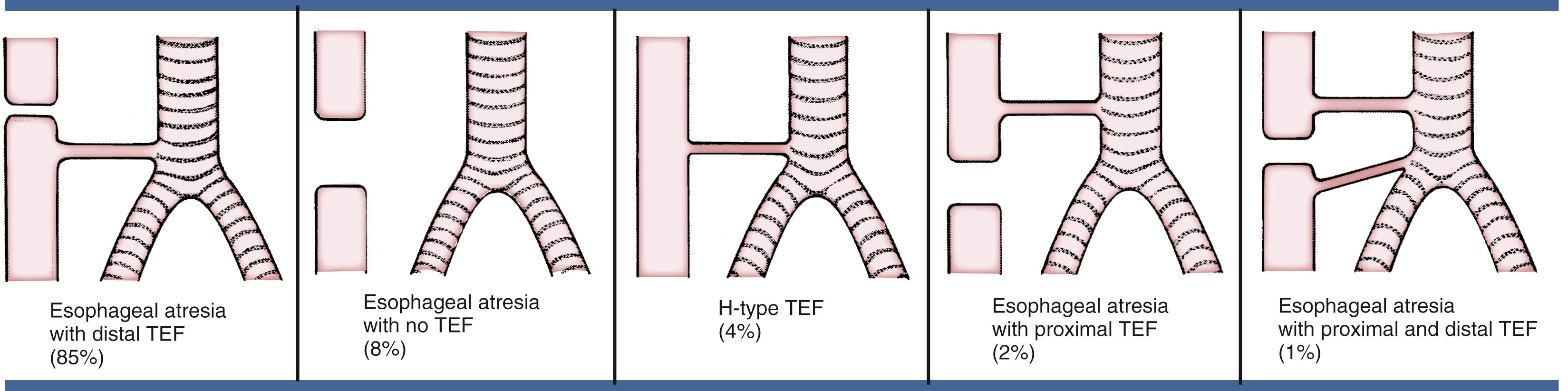 Fig. 15.2, Various types of tracheoesophageal fistulas (TEFs) with relative frequency (%).