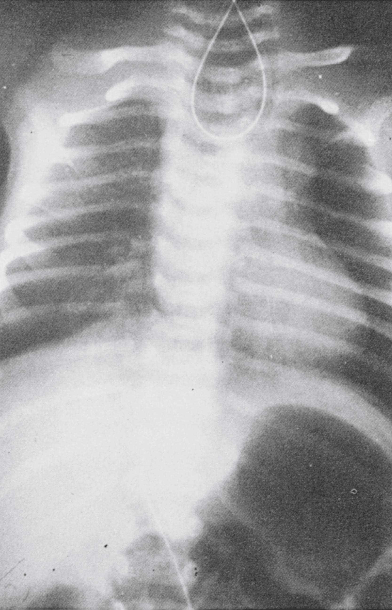 Fig. 15.3, Tracheoesophageal fistula. Coiled radiopaque nasogastric tube in blind upper pouch.