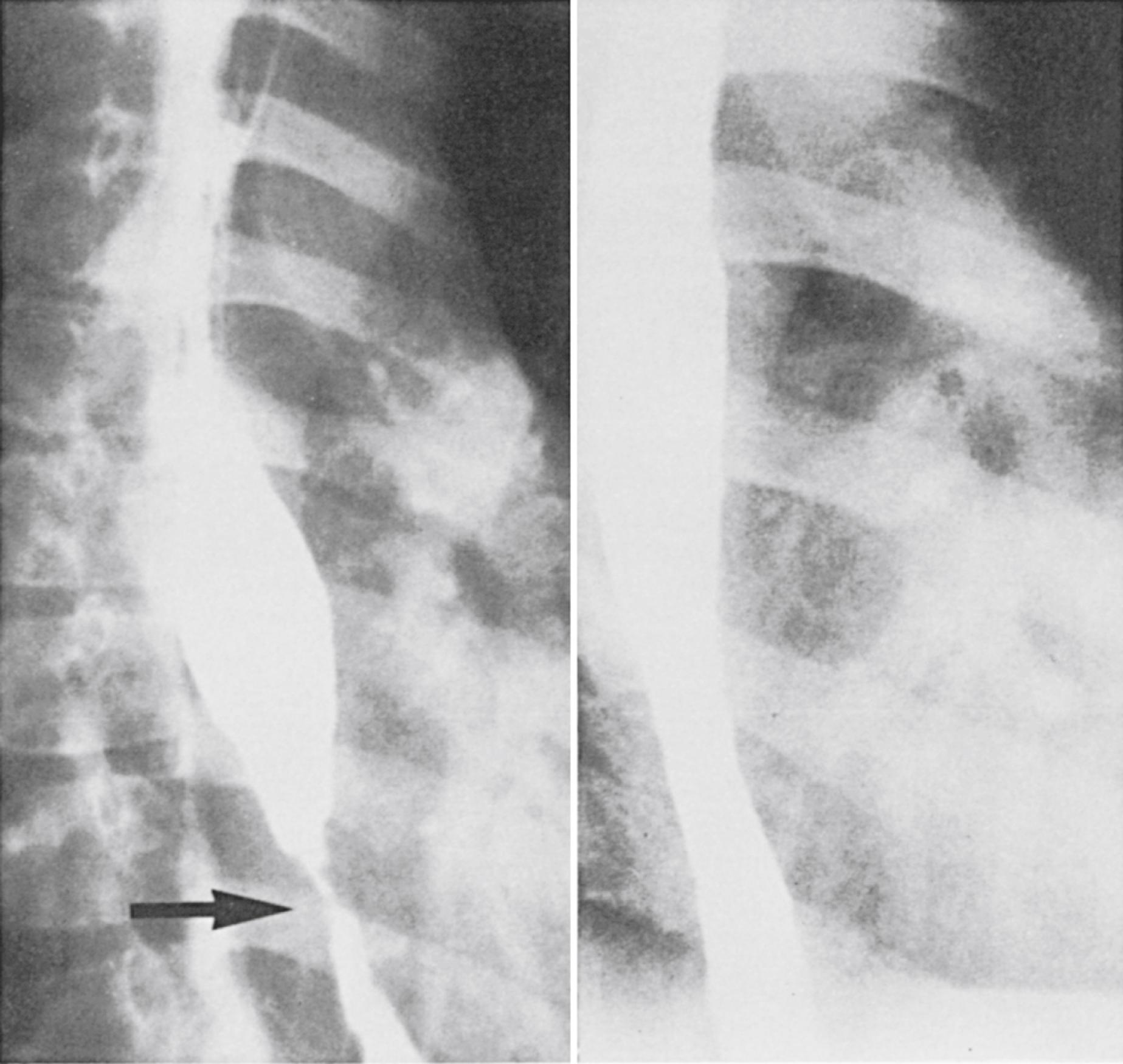 Fig. 15.4, Esophageal stricture. Radiograph of a peptic esophageal stricture (arrow) before and after treatment with dilations.