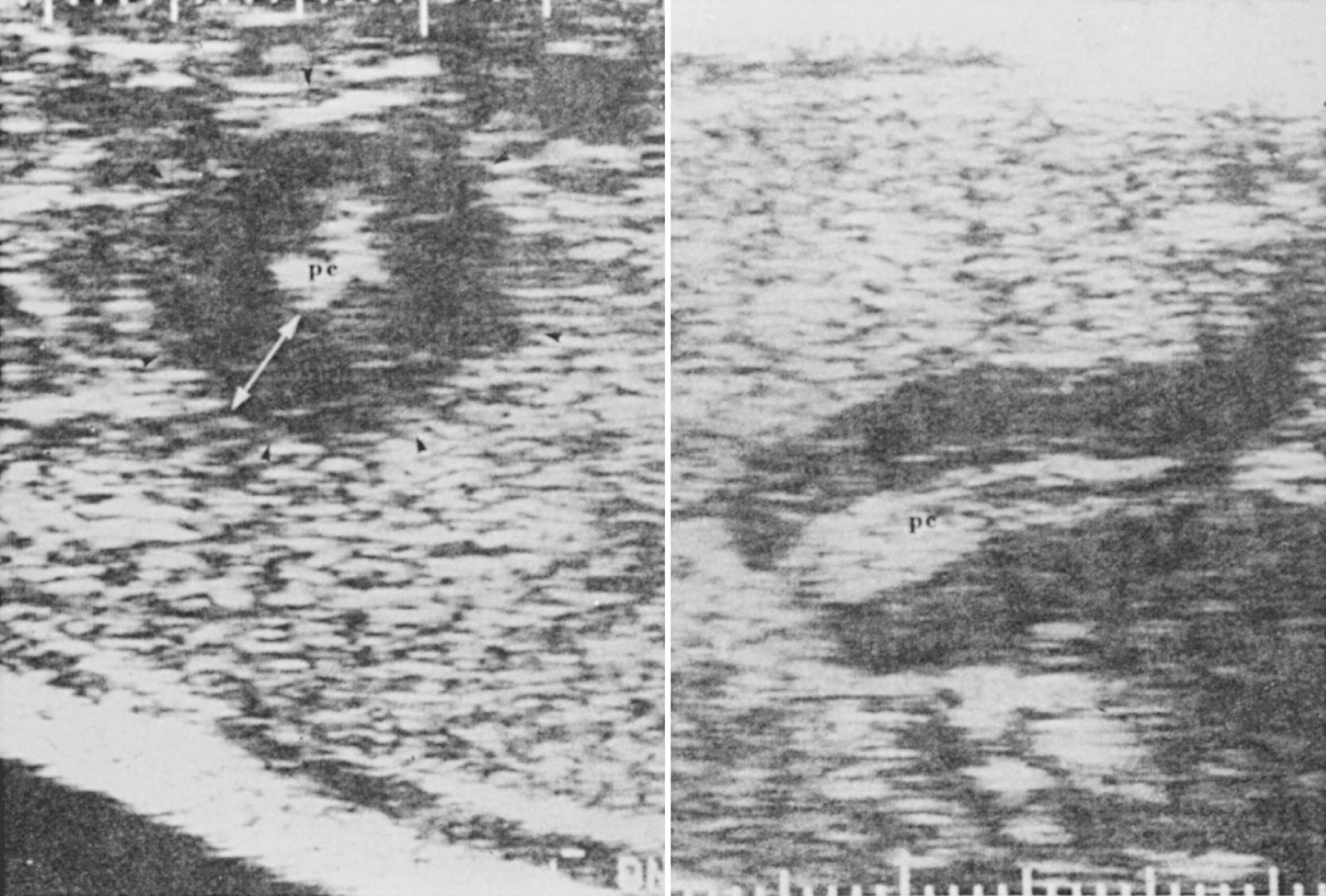 Fig. 15.5, Pyloric stenosis. Cross-sectional (left) and transverse (right) sonograms of hypertrophic pyloric stenosis, showing increased thickness and length of pyloric muscle. pc, pyloric channel.