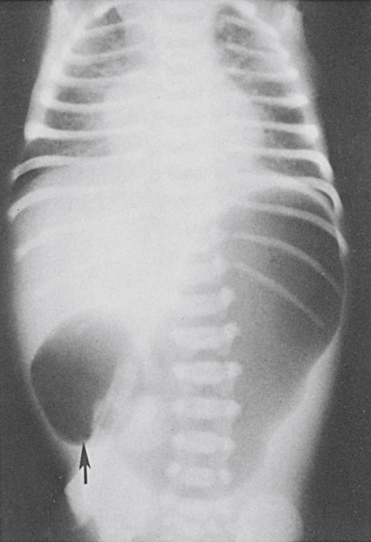 Fig. 15.6, “Double-bubble” sign (arrow) in duodenal obstruction.