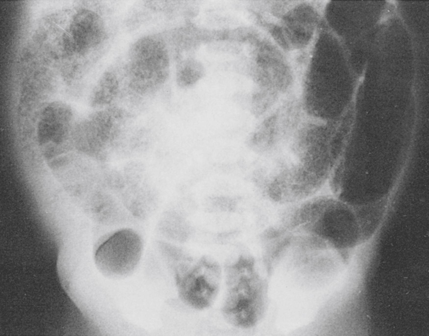 Fig. 15.7, Soap-bubble appearance in meconium ileus.