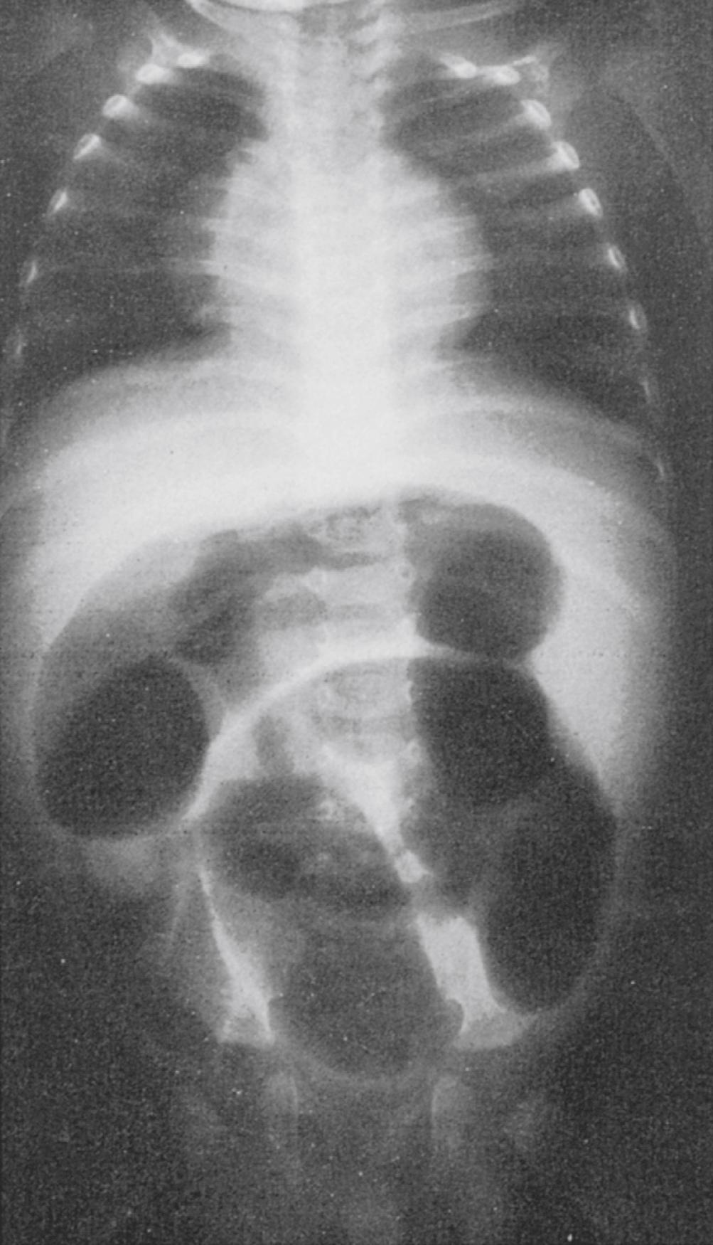 Fig. 15.8, Diffusely dilated bowel loops in intestinal obstruction.