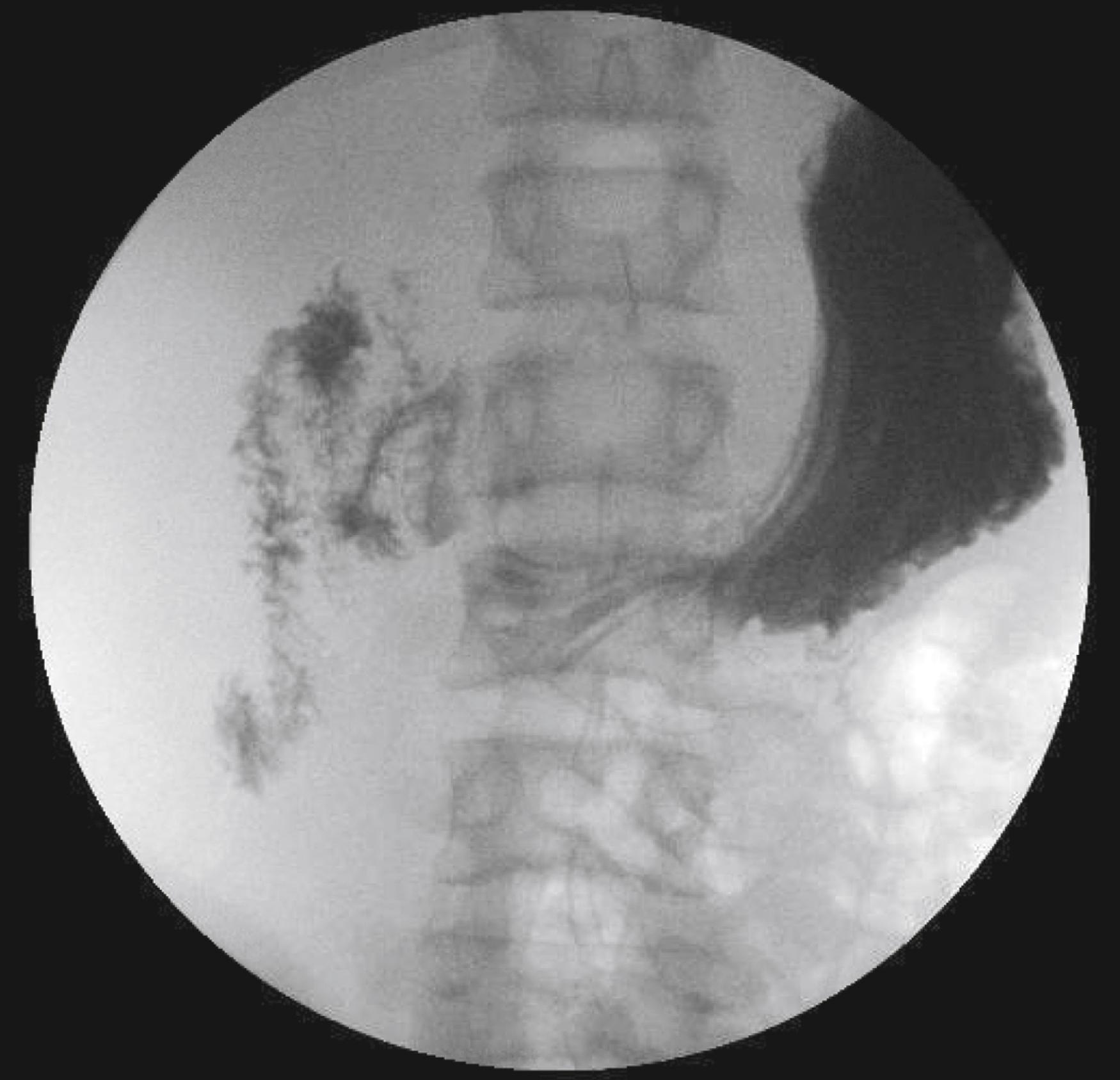 Fig. 15.9, Contrast fluoroscopy (upper gastrointestinal series) demonstrating malrotation. Note the small bowel fills with contrast all to the right of midline and does not cross over the left upper quadrant where the ligament of Treitz would be normally located.