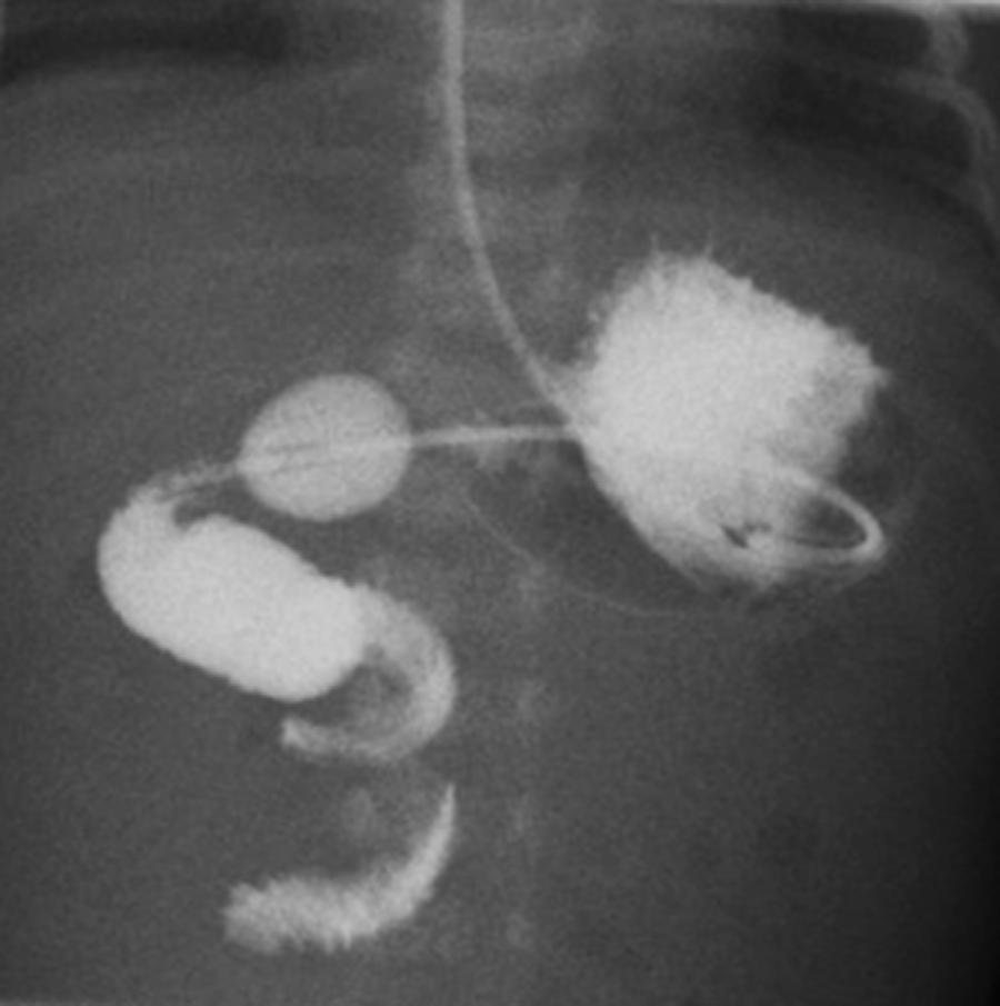 Fig. 15.10, Corkscrew sign: spiral appearance of the distal duodenum and proximal jejunum in the setting of midgut volvulus on contrast studies.