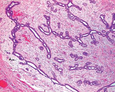 Figure 30.1, Fibroadenoma of vulva arising from ectopic breast tissue.