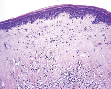 Figure 30.4, Lichen sclerosus of vulva. A thick hypocellular edematous layer is bounded by atrophic epidermis on one side and inflamed stroma on the other.