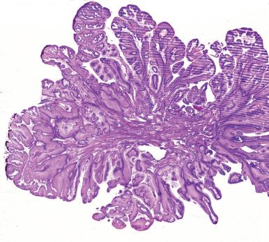 Figure 30.6, Whole mount of condyloma acuminatum of vulva.