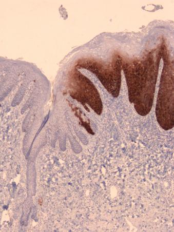 Figure 30.9, “Block” immunoreactivity for p16, with strong nuclear and cytoplasmic staining of all cells of at least the basal third of the epithelium, in HSIL (VIN2/3), as a surrogate test for the presence of oncogenic HPV.