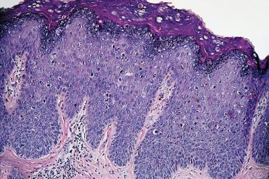 Figure 30.10, Typical microscopic appearance of HSIL (VIN2/3).