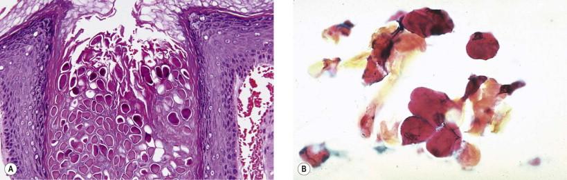 Figure 11-1, Molluscum contagiosum of the vulva. (A) Histology of molluscum contagiosum (H&E, ×200); (B) cytology of molluscum bodies with dense eosinophilic cytoplasm (Papanicolaou, ×LP).