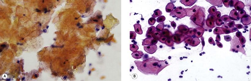 Figure 11-4, Hyperplastic dystrophy of the vulva. (A) Hyperkeratotic cells with anuclear orangeophilic cytoplasm. (B) Parakeratosis (Papanicolaou, ×MP).