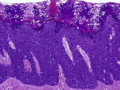 Figure 11-5, Classic type of VIN III (H&E, ×LP).