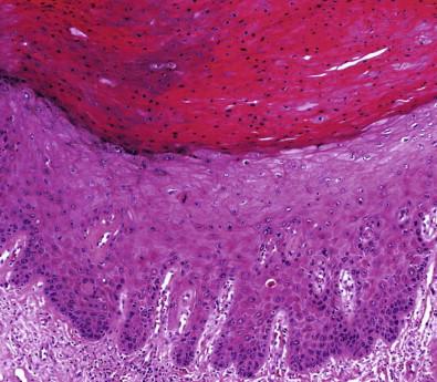 Figure 11-6, Differentiated (Simplex) type of VIN (H&E, ×LP).