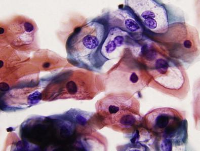 Figure 11-7, Low-grade VIN (VIN I), classic type. Superficial atypical squamous cells with enlarged nuclei and paranuclear halos (koilocytosis) (Papanicolaou, ×HP).