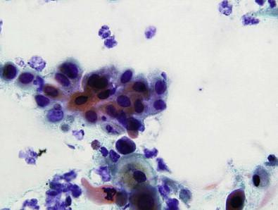 Figure 11-8, High-gradeVIN (VIN III), classic type. Dysplastic squamous cells with slightly enlarged nuclei and higher N : C ratio (Papanicolaou, ×HP).