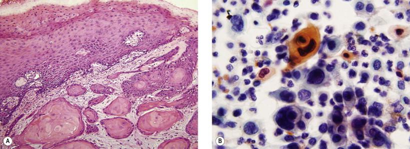 Figure 11-9, Keratinizing SCC of the vulva. (A) Histopathologically malignant squamous eddies infiltrating superficially in the dermis of the vulva (H&E, ×LP). (B) Cytologically malignant squamous cells showing marked nuclear and cytoplasmic pleomorphism and atypical keratinized pearl formation (Papanicolaou, ×HP).
