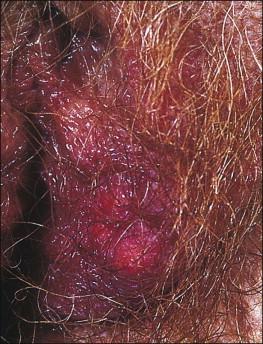 Figure 5.1, Follicular cysts (‘epidermal inclusion cysts’). Ruptured cysts become inflamed as a result of foreign body giant cell reaction to keratin leakage.