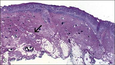 Figure 5.12, Paget disease involving sweat glands. (A) Low-power section of skin in which the involved gland (arrow) extends near to the cutaneous fat. (B) Detail of gland cut in cross section.