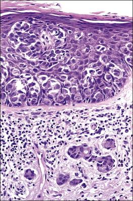 Figure 5.13, Invasive Paget disease.