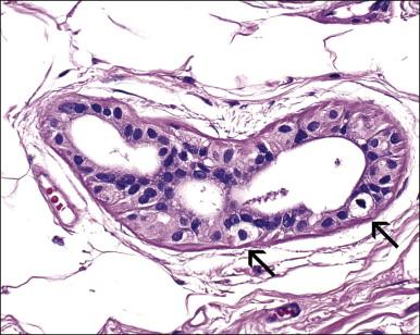 Figure 5.14, Toker cells (arrows) with abundant clear cytoplasm in an isolated anogenital mammary-like gland of the vulva.