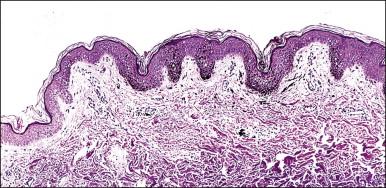 Figure 5.15, Lentigo. Note the hyperpigmentation of basal keratinocytes without apparent increase in the number of melanocytes.