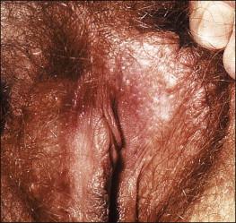 Figure 5.2, Steatocystoma multiplex. This inherited disorder, sometimes involving the genitalia, shows multiple creamy-colored cysts.