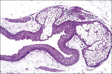 Figure 5.3, Steatocystoma multiplex. Characteristic features include an apparently collapsed cyst with sebaceous units in the wall and a densely eosinophilic thin lining cuticle.