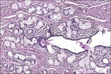 Figure 5.4, Normal Bartholin gland. Simple tubuloalveolar glands with mucin-producing alveoli drain eventually into a central duct lined by transitional epithelium.