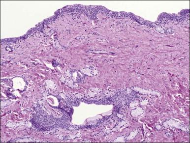 Figure 5.5, Bartholin cyst. The cyst wall (top) is lined by transitional epithelium as it is a duct (center) surrounded by normal mucus glands.