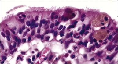 Figure 5.6, Bartholin gland cyst with ciliated cells.