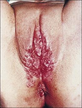 Figure 5.7, Paget disease, which extends to involve the perianal region.