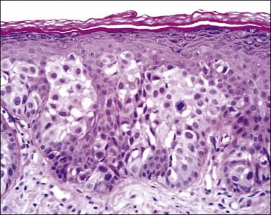 Figure 5.8, Paget disease. Nests of pale-staining tumor cells are located within the epidermis including the upper layers. The nests compress the basal layer of squamous cells.