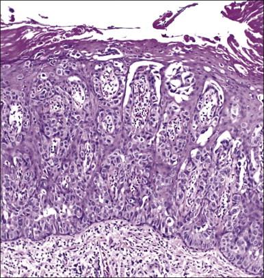 Figure 5.9, Massive Paget disease in which virtually the entire epidermis has been replaced.