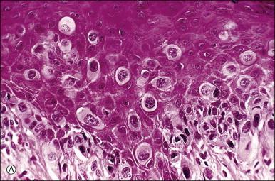 Figure 5.10, Paget disease. (A) The tumor cells have abundant pale cytoplasm and are arranged singly or in small clusters within the epidermis. They appear larger than the surrounding keratinocytes. (B) Paget cells express CK7 and (C) CEA.