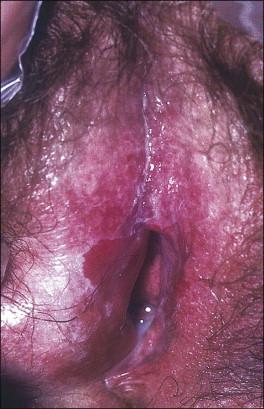 Figure 3.12, Erosive lichen planus. Bright patches of eroded epithelium with a shaggy white edge are present at the vulvar vestibule. Vaginal disease may be present.