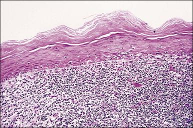 Figure 3.13, Lichen planus. The epidermis shows hyperkeratosis, extensive basal layer destruction, and a dense lichenoid infiltrate at the dermoepidermal junction. In the vulva, the histologic changes are not always as florid and classic as shown here.
