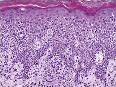 Figure 3.3, Subacute vulvar dermatitis. The epidermis shows both active focal spongiosis (acute dermatitis changs) and rete ridge elongation with collagenization in dermal papillae (chronic dermatitis change).