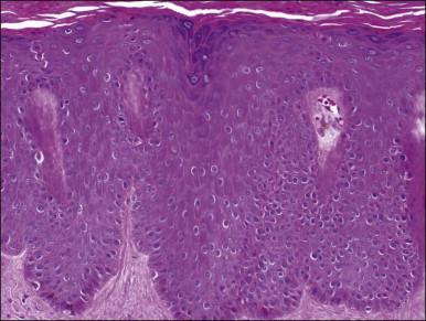 Figure 3.6, Lichen simplex chronicus. The epidermis shows thickening of rete ridges, thickening of the granular layer, and overlying hyperkeratosis.