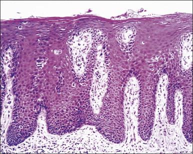 Figure 3.7, Psoriasis. There is psoriasiform hyperplasia of rete ridges with papillary dermal edema and telangiectasia. The parakeratotic scale on the skin surface is not prominent in vulvar psoriasis.