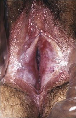 Figure 3.8, Lichen sclerosus. Classic white areas with purpura are present on the labia majora and minora. Partial reabsorption of labia minora is seen.