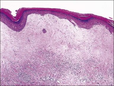 Figure 3.9, Lichen sclerosus. There is a broad band of hyalinized collagen beneath the epidermis, and a band of lymphocytic infiltrate beneath the hyalinization. The characteristic hyalinized band may be very narrow.