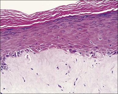 Figure 3.10, Lichen sclerosus. A characteristic feature of lichen sclerosus is irregular damage to the basal layer of the epidermis.