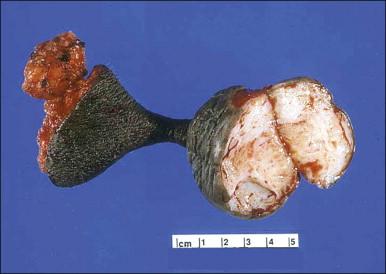 Figure 6.1, Fibroepithelial–stromal polyp. Lesions are typically a polypoid/pedunculated mass.