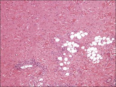 Figure 6.12, Prepubertal fibroma. The lesion is typically poorly marginated with infiltration into adipose tissue.