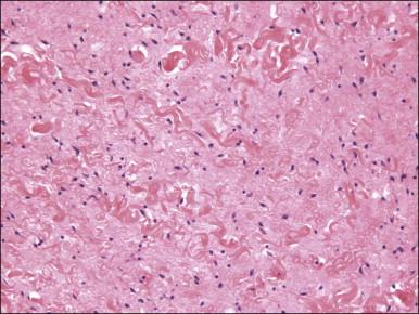 Figure 6.13, Prepubertal fibroma. Hypocellular proliferation of bland spindle cells set within a collagenous matrix.