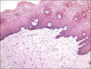 Figure 6.2, Fibroepithelial–stromal polyp. The lesion extends up to the epithelial interface without a clearly definable margin.