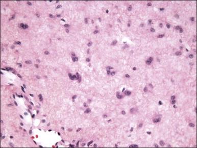 Figure 6.3, Fibroepithelial–stromal polyp. Characteristic appearance of the stellate and multinucleate stromal cells.