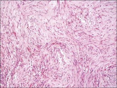 Figure 6.5, Nodular fasciitis. Somewhat fascicular proliferation of spindle cells within an edematous matrix containing extravasated red blood cells.