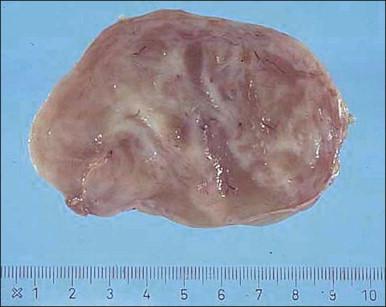 Figure 6.6, Angiomyofibroblastoma. Well-demarcated, tan/white mass.